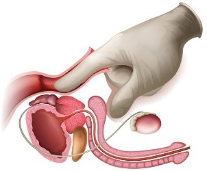 prostatas masāža