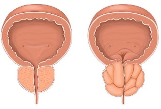 Prostatīts