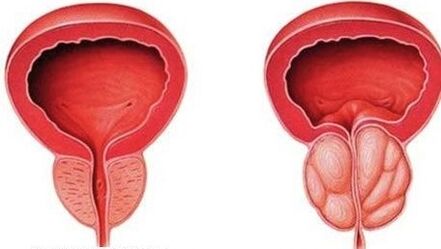 normāla un iekaisusi prostata