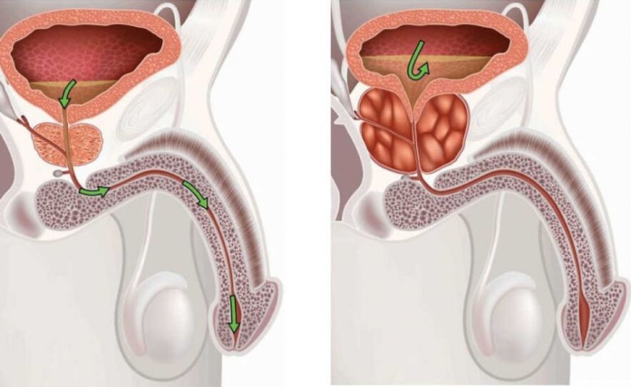 veselīga un slima vīriešu prostata