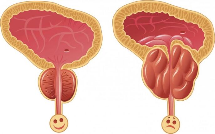 veselīga un iekaisusi prostata ar prostatītu