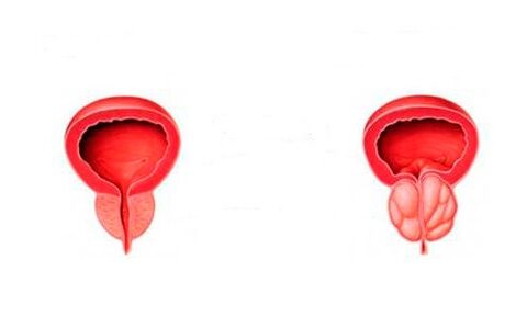veselīga un iekaisusi prostata ar prostatītu