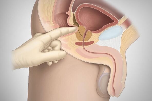 Prostatas masāža bakteriāla prostatīta ārstēšanai