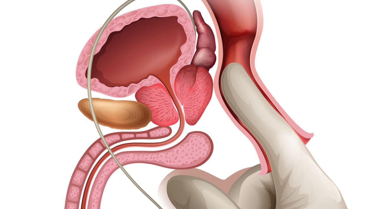 Prostatas masāža ir efektīvs līdzeklis sastrēguma prostatīta ārstēšanai