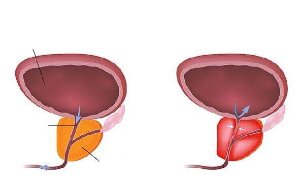 normāla un iekaisusi prostata